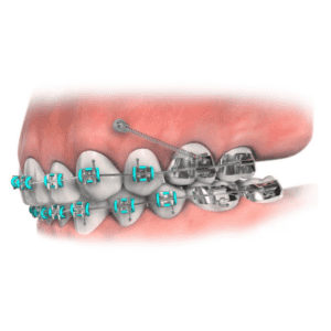 Invisible Braces for Crooked Teeth In Wichita KS